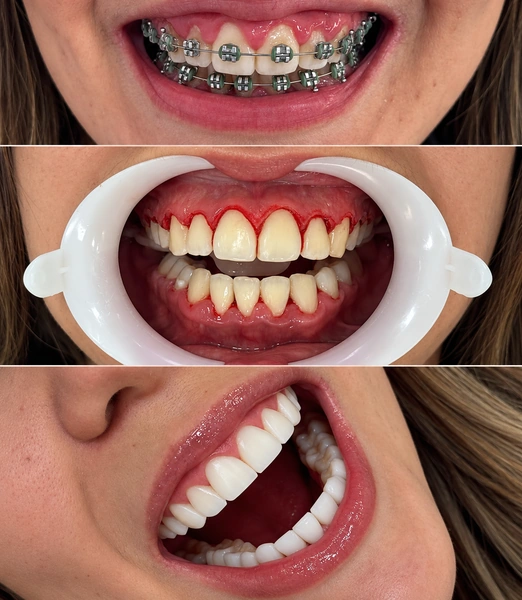 Caso de gengivoplastia com antes e depois