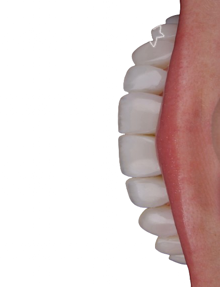 Sorriso com lentes em resina em recorte lateral