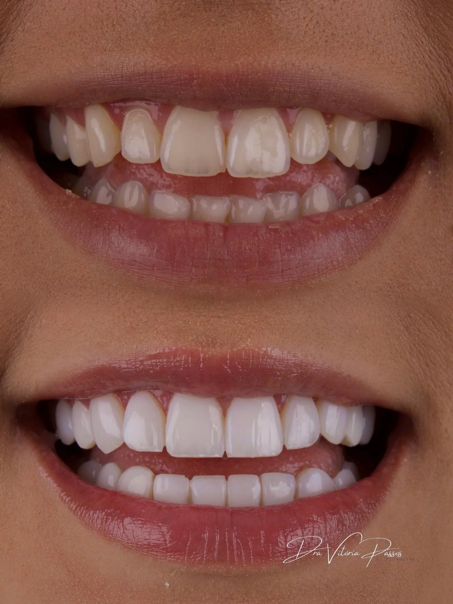 Antes e depois com sorriso mais claro, harmônico e sofisticado.