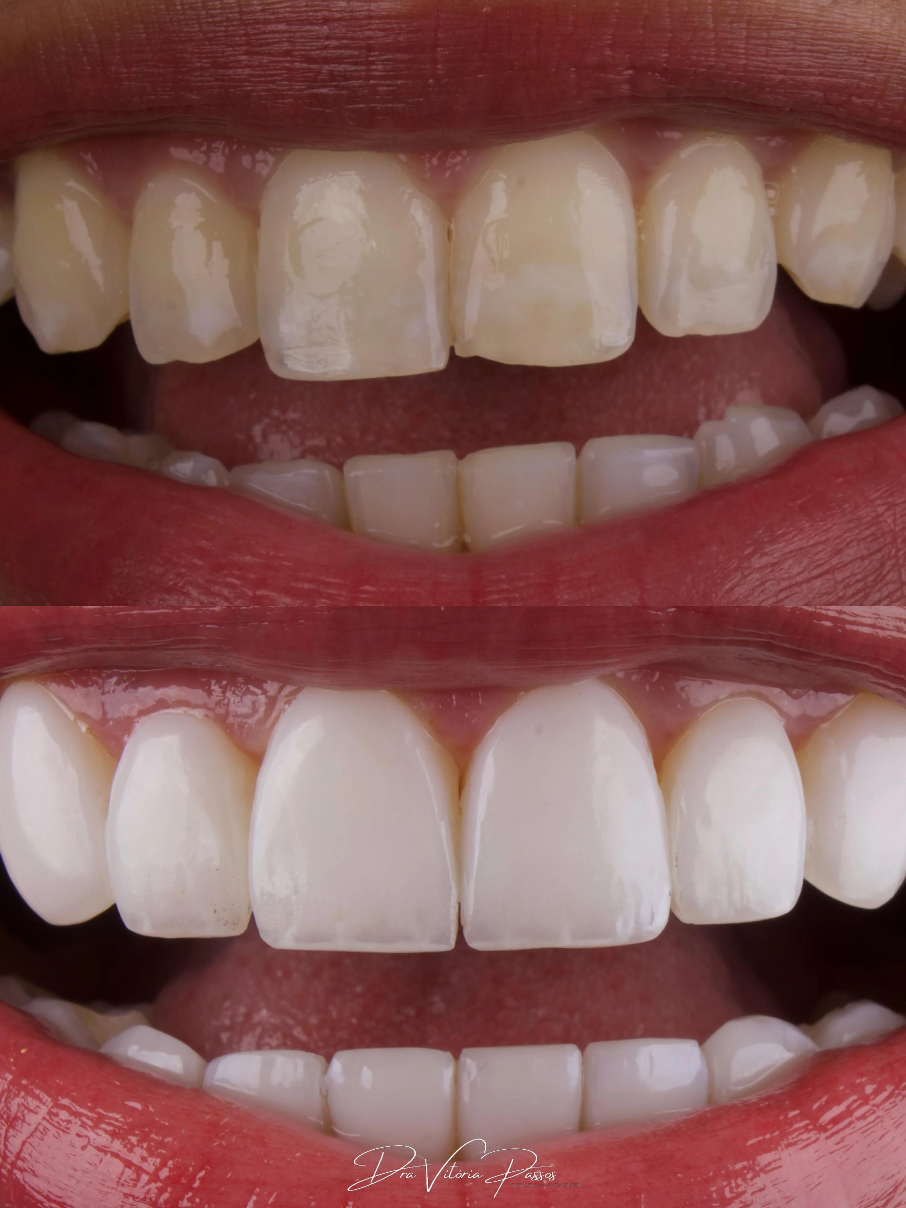 Detalhe de facetas com mudança de brilho, proporção e acabamento.
