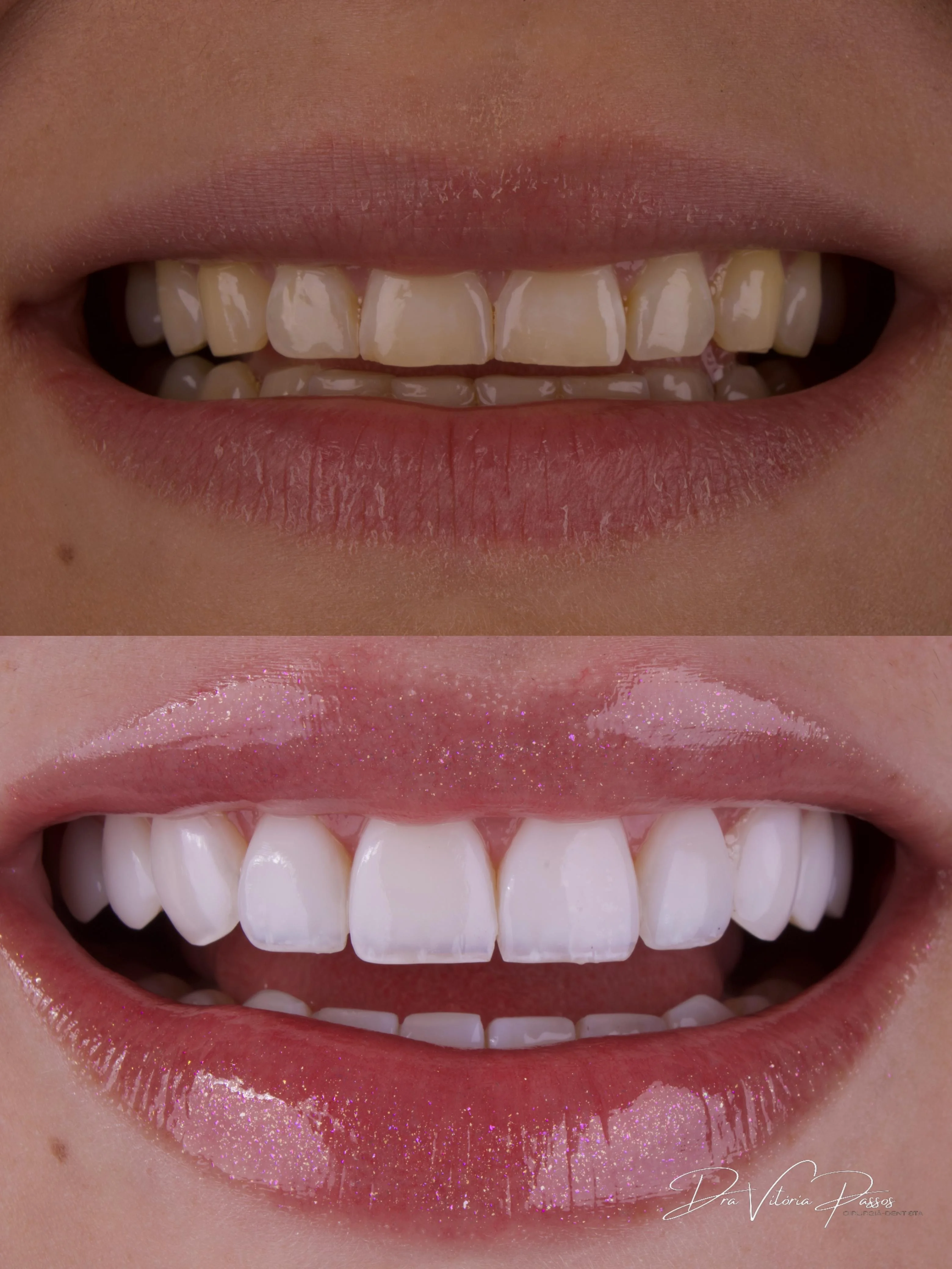 Transformação premium com sorriso mais branco e lábios em destaque.