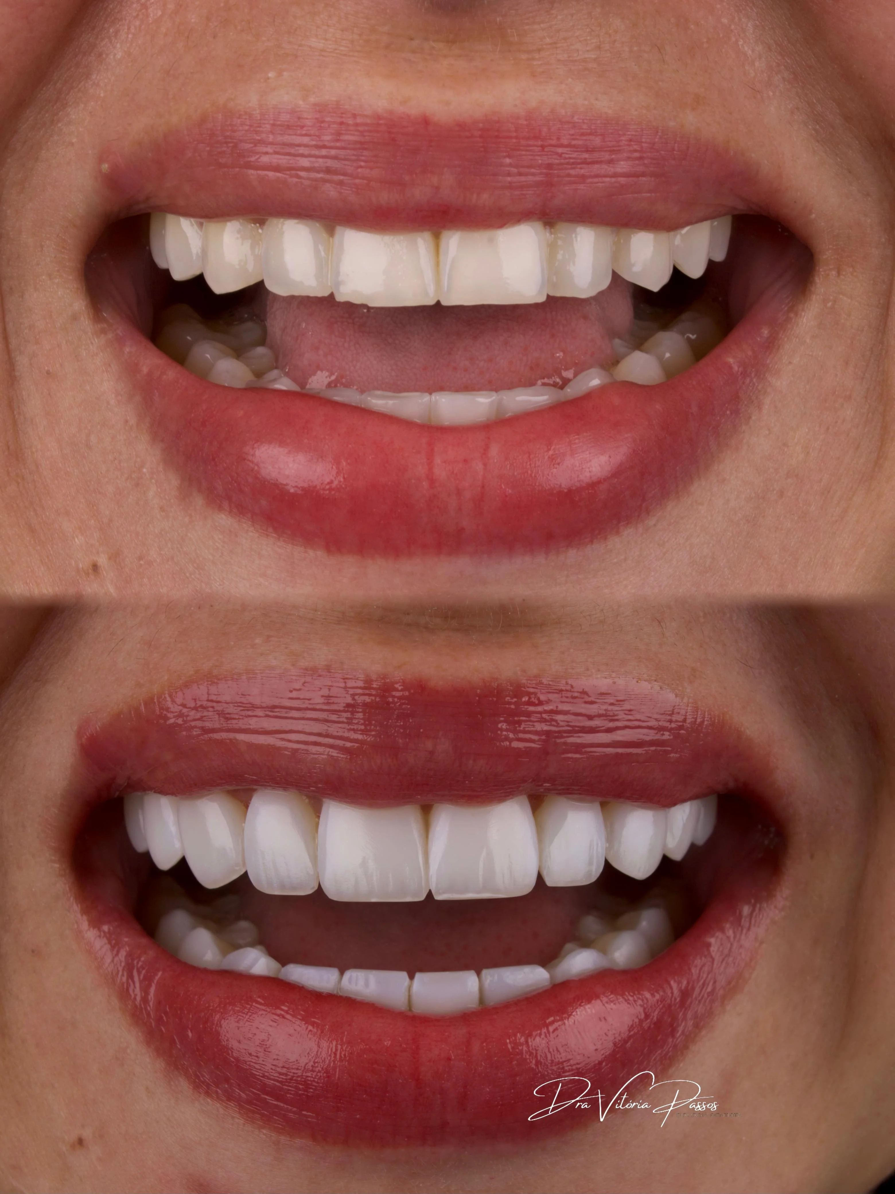 Sorriso renovado com proporção equilibrada e acabamento delicado.