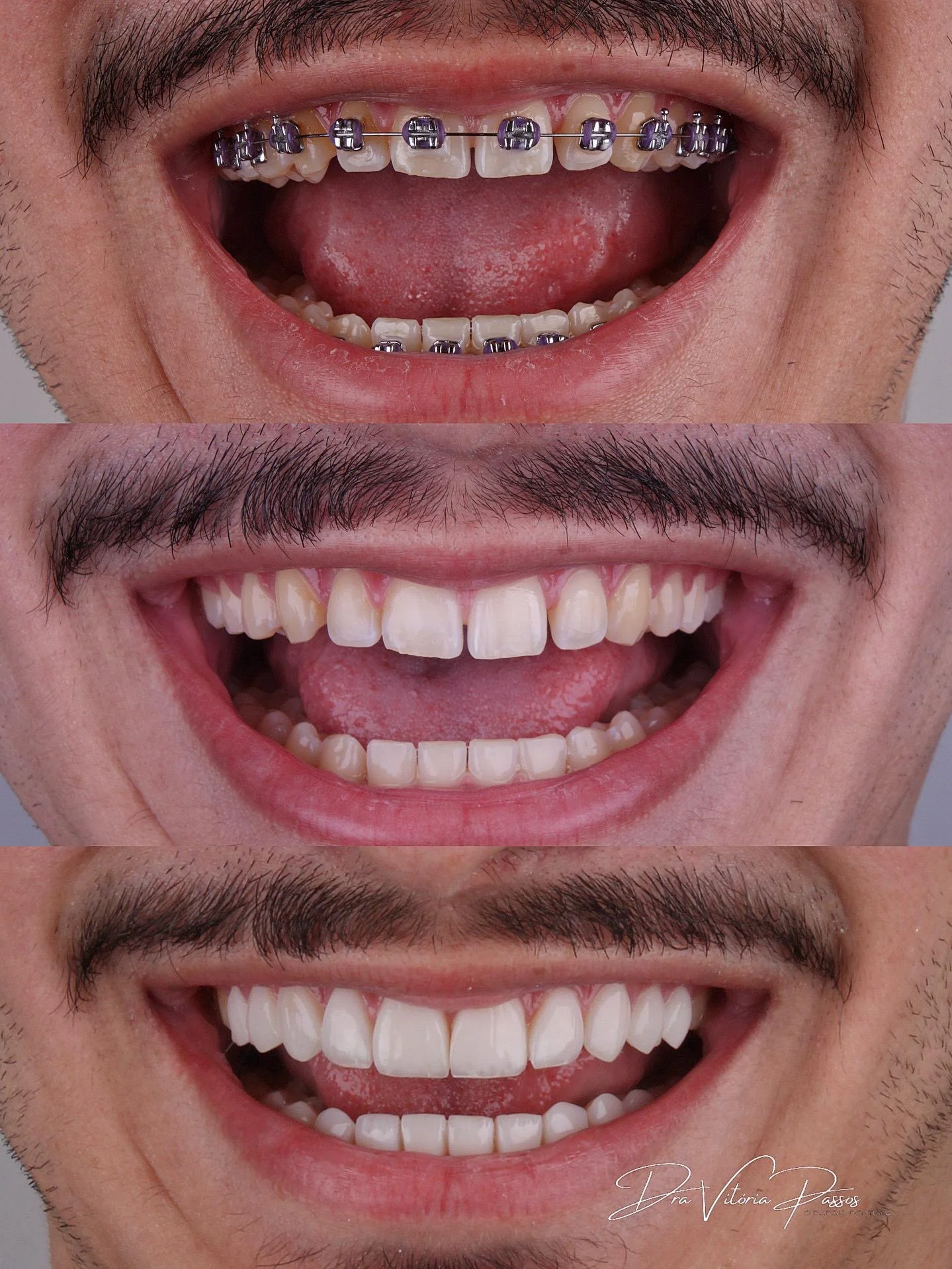 Evolução completa do sorriso com planejamento estético integrado.