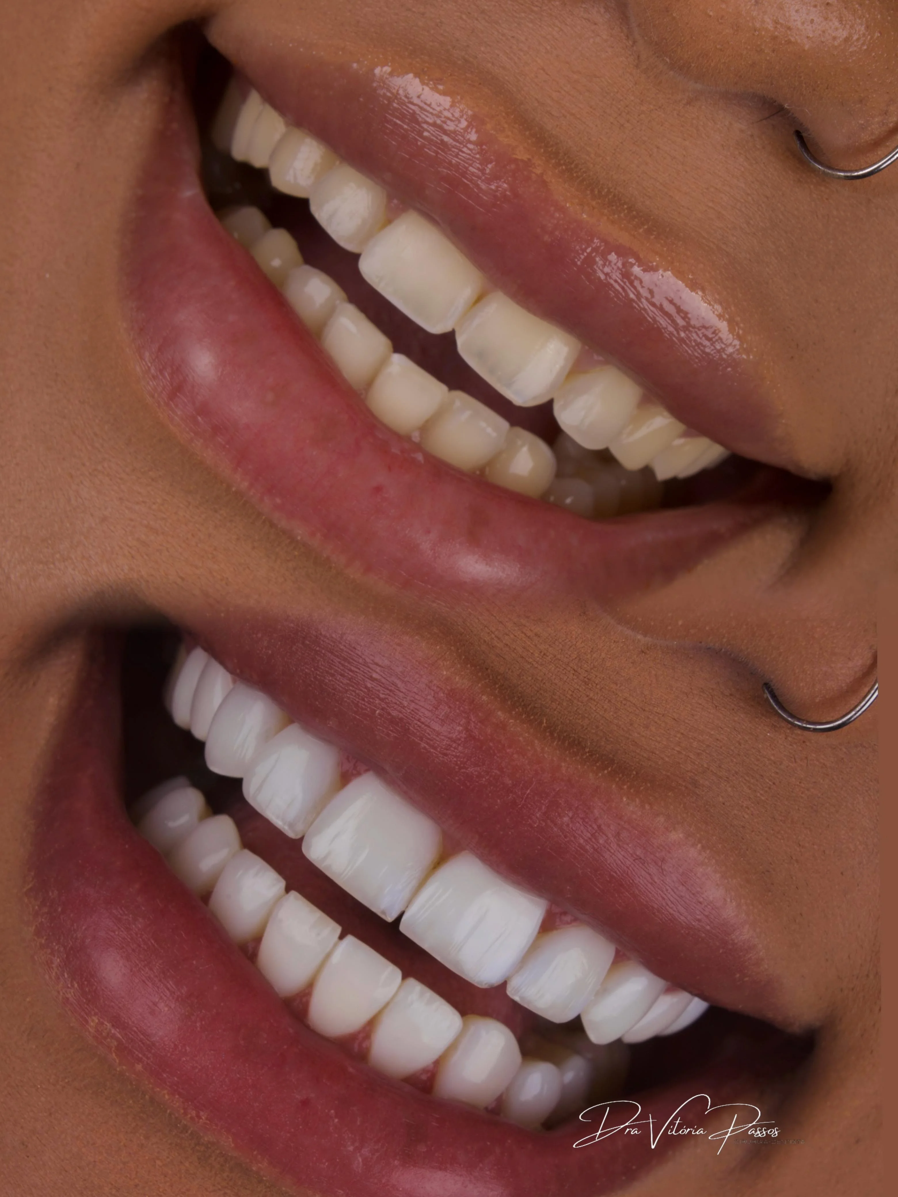 Resultado premium em ângulo lateral com brilho e naturalidade.