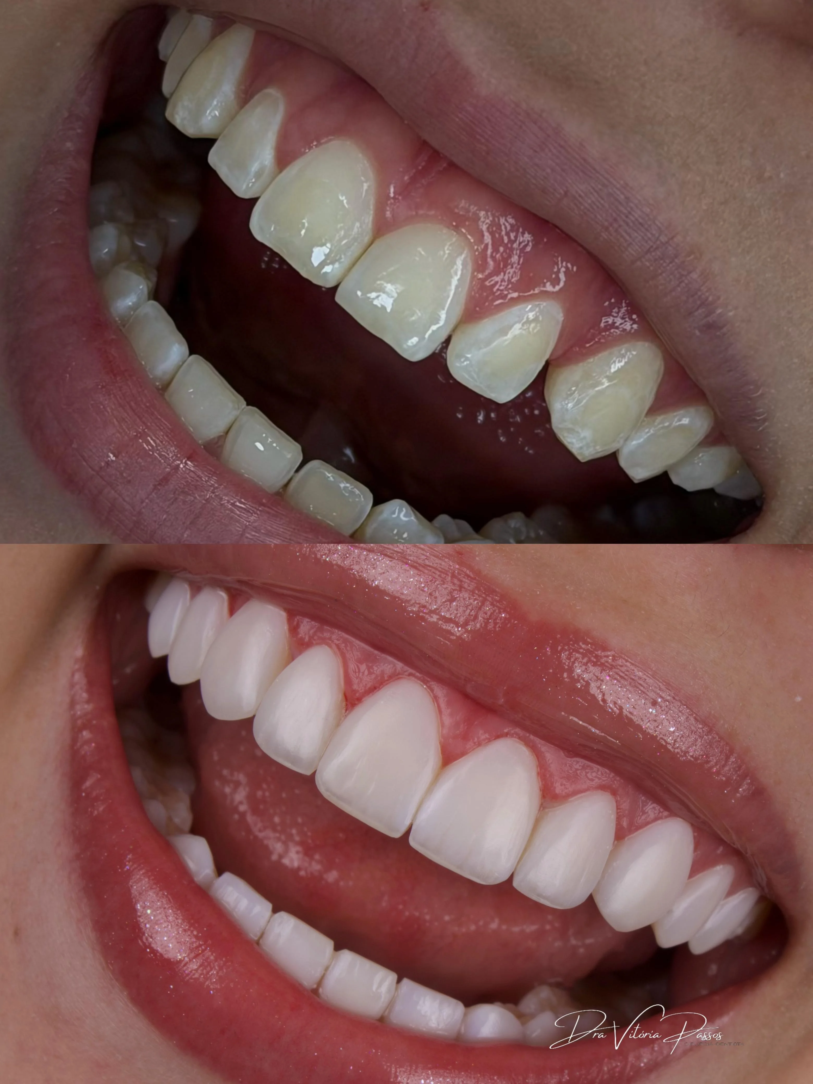 Antes e depois em detalhe lateral com dentes mais claros e harmônicos.