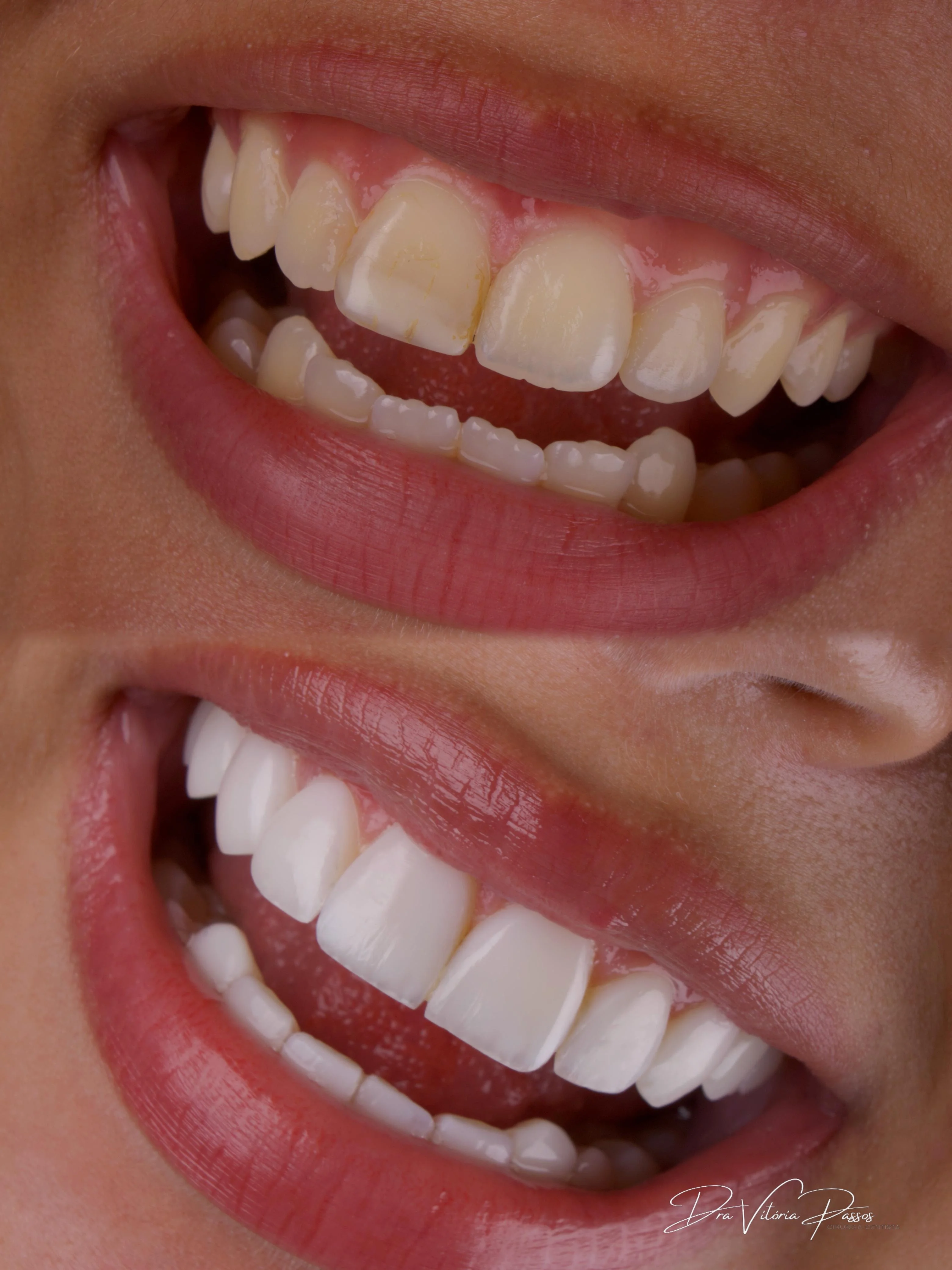 Transformação lateral com facetas claras e leitura natural do sorriso.