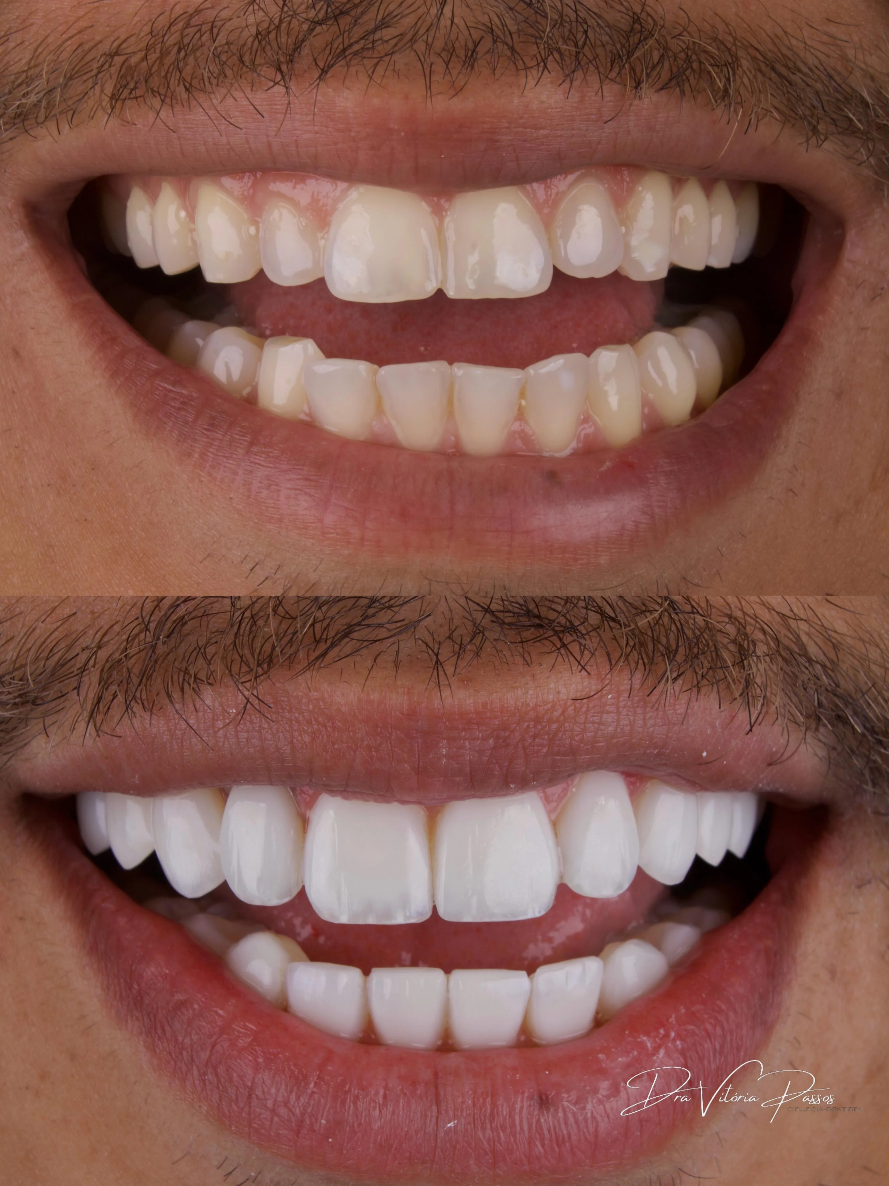 Antes e depois masculino com sorriso mais alinhado e luminoso.