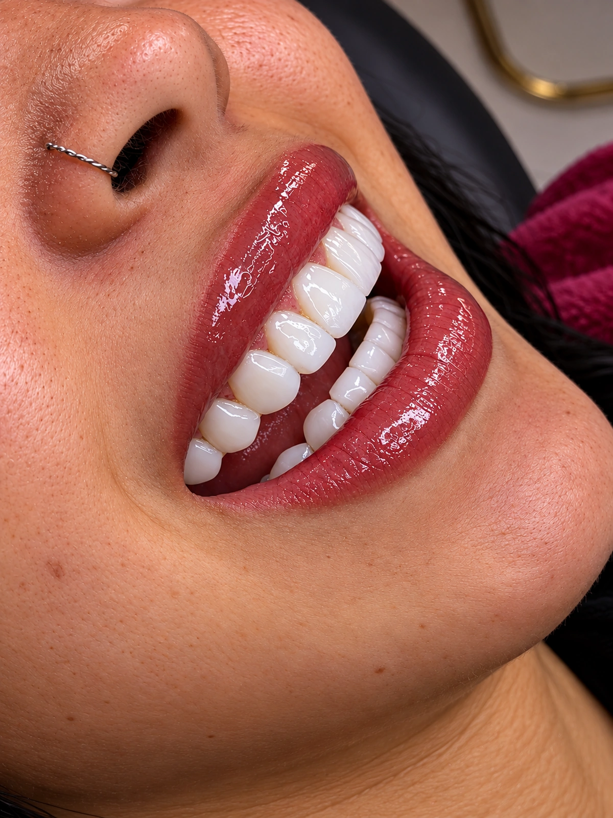Sorriso em detalhe com Lentes Tradicionais e proporção equilibrada.
