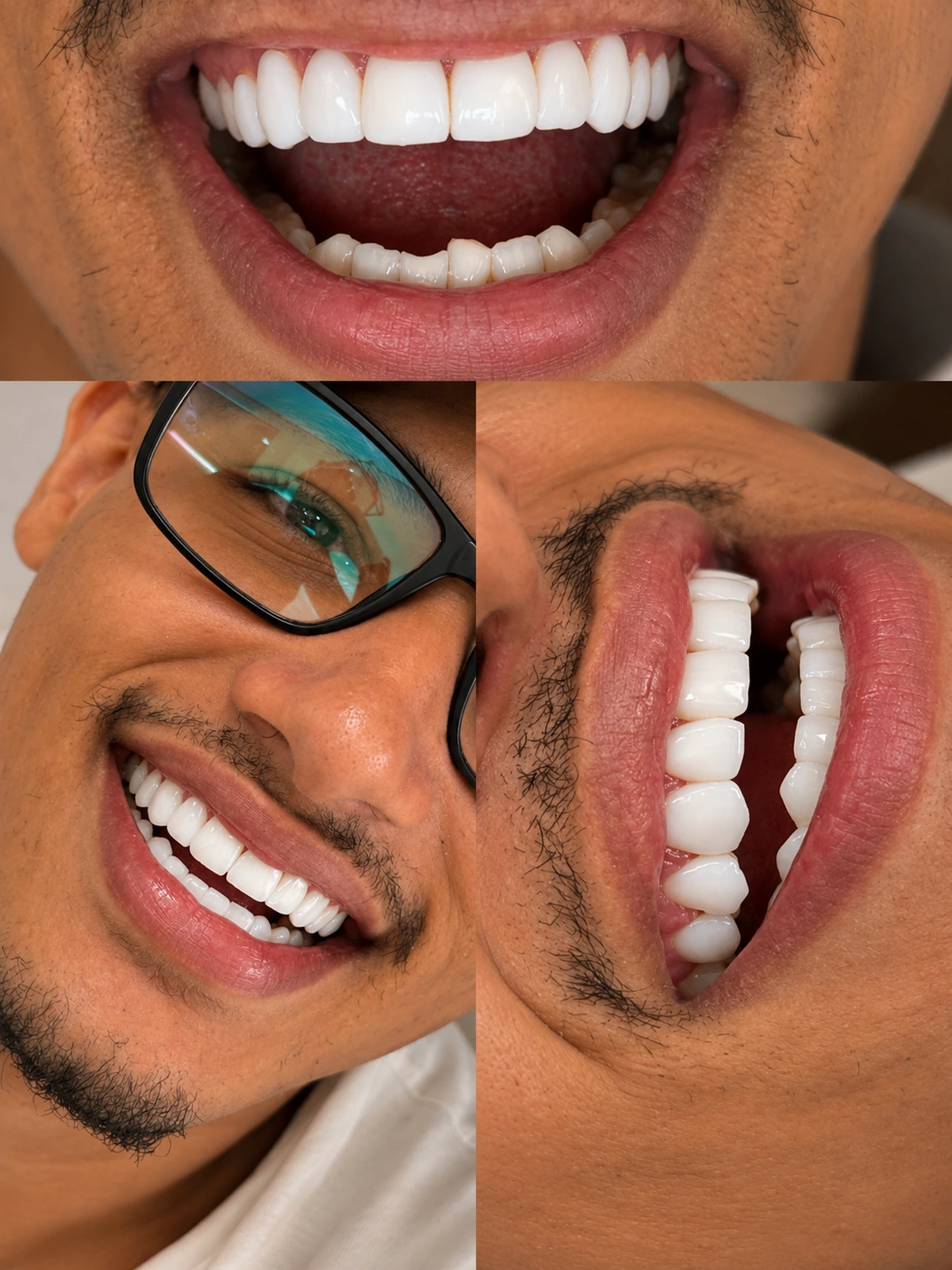 Sorriso masculino com Lentes Tradicionais e acabamento leve.