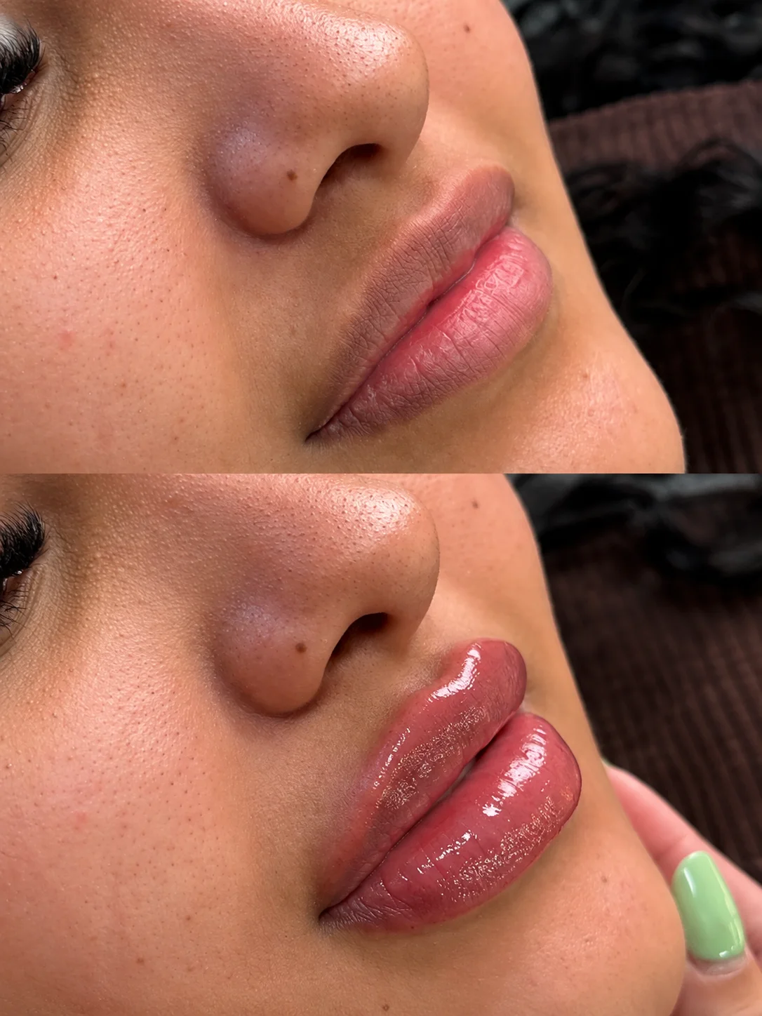 Caso de preenchimento labial com antes e depois na mesma imagem